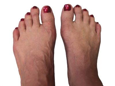 hallux_valgus_postop copy